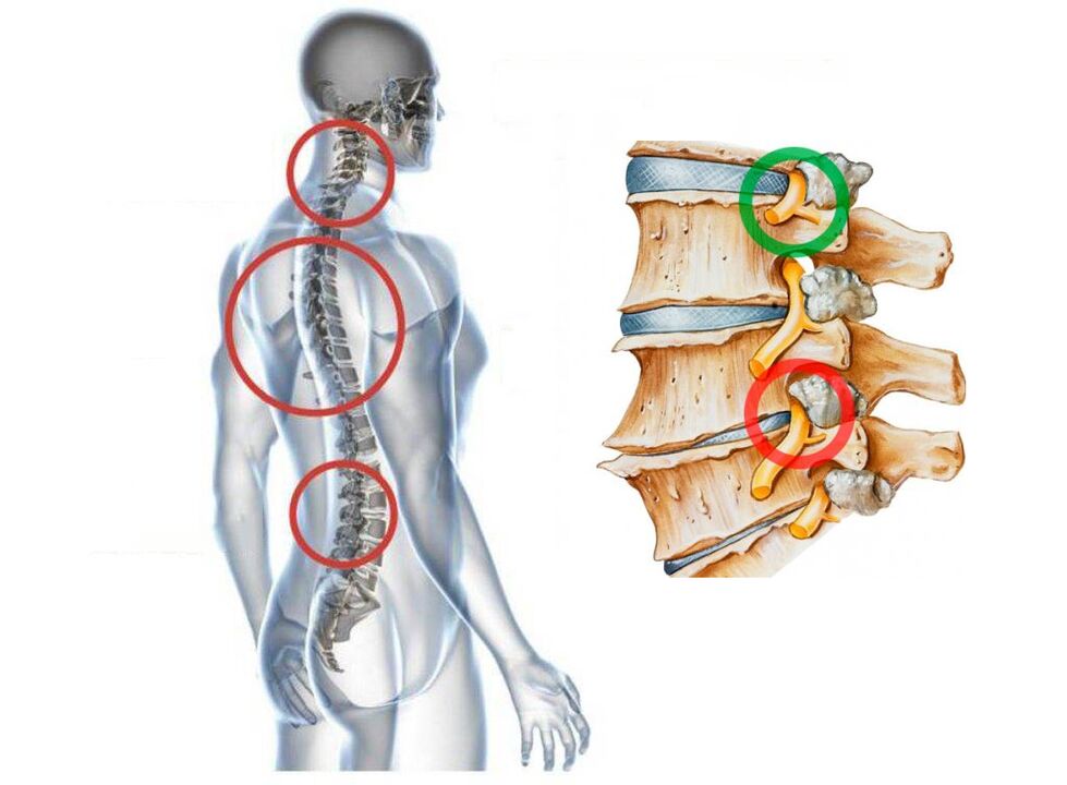 Vertebraning bachadontal ostondroz nimaga o'xshaydi