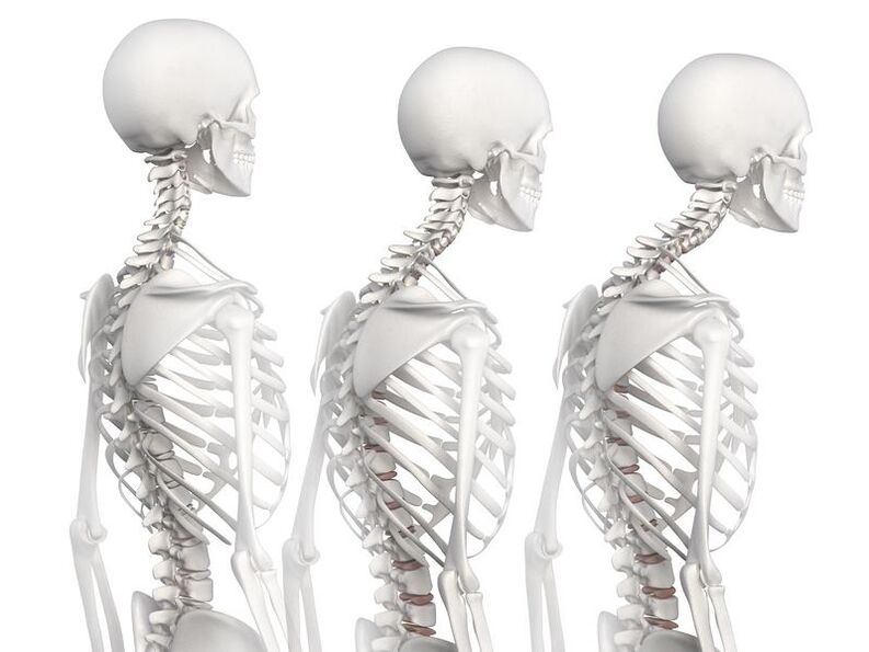 Skelet modeli misolida torakal osteoxondrozning rivojlanish darajalari