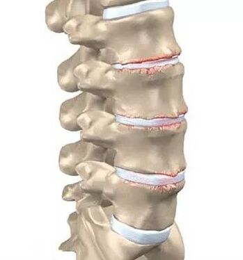 Osteochonroz